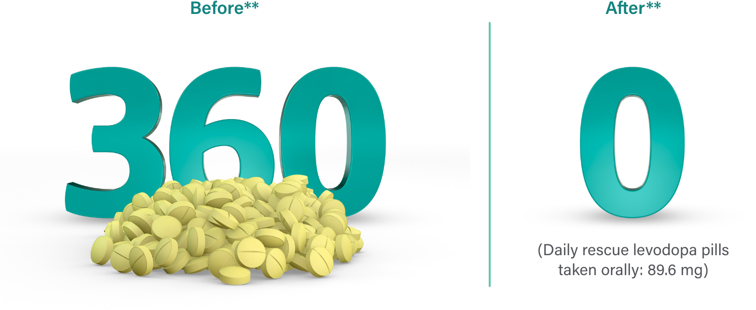 During a 30 day average, VYALEV™ patients were taking 360 IR CD/LD pills per month at baseline and 0 IR CD/LD pills per month at 12-week study end.