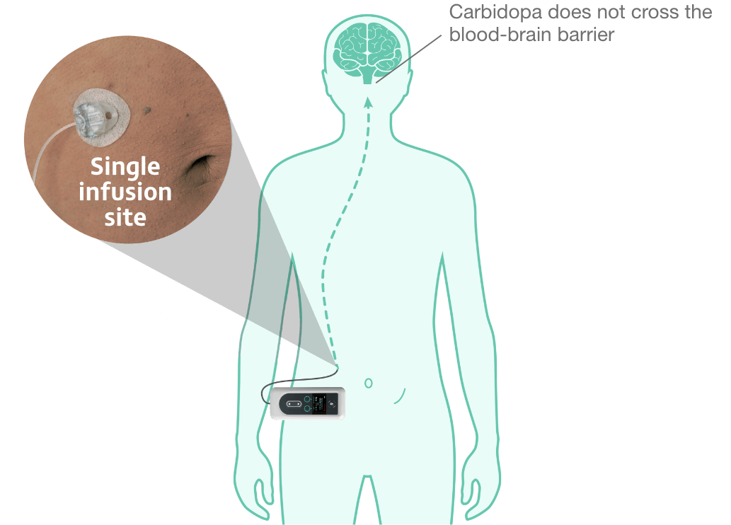 Single infusion site. Carbidopa does not cross the blood-brain barrier.